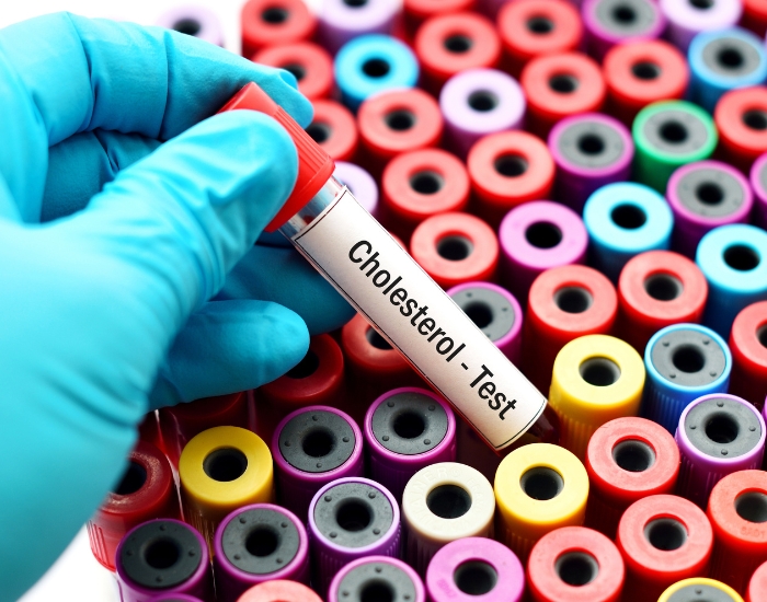 URL (Slug) Symptoms of High Cholesterol: Warning Signs, Causes & Treatment